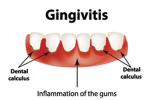 Signs of gingivitis