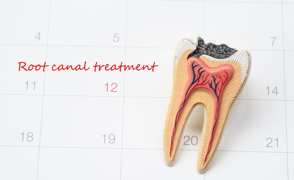 A decayed tooth on a calendar date of when the patient is getting root canal treatment