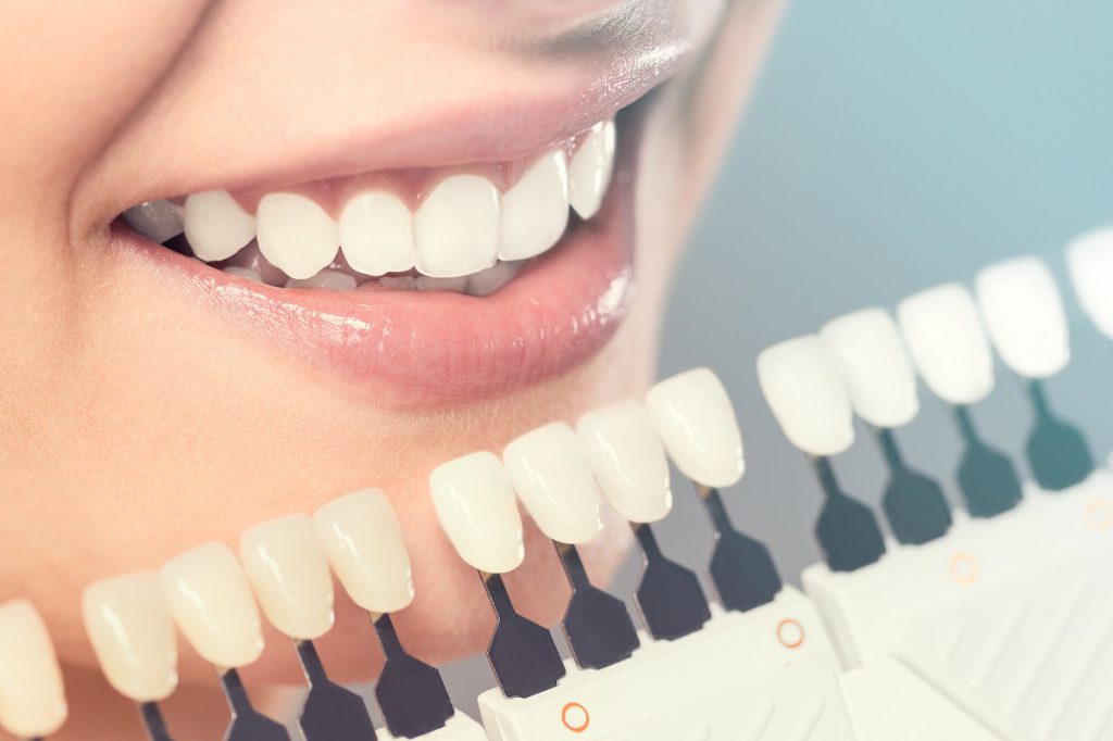 A dental patient having porcelain veneers compared to her teeth