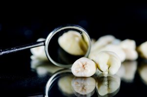 Teeth lost by a patient and a dental mirror