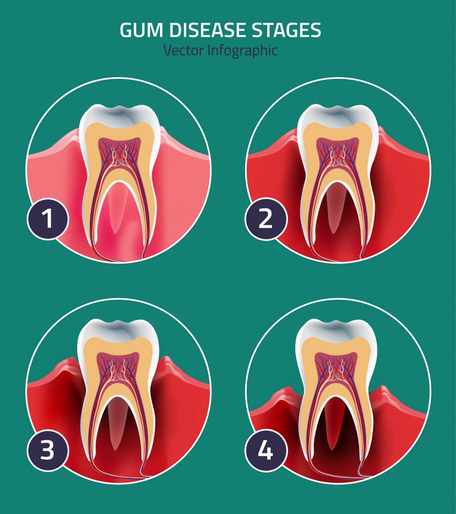 The 4 stages of gum disease
