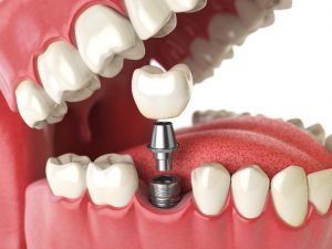 Infographic showing a dental implant