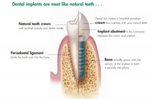 Infographics showing the benefits of dental implants