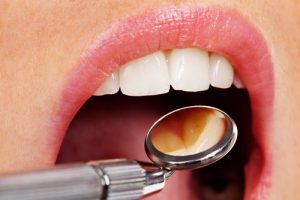 Dentist examining a mouth before a root canal