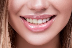 Women's smile showing before and after laser teeth whitening