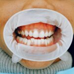What causes gum recession and how can you prevent it?