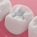 When Do You Need A Root Canal vs. A Filling?