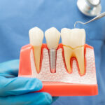How Dental Implants Prevent Bone Loss and Protect Oral Health