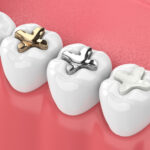 Silver Fillings vs. Tooth-Colored Fillings: What’s the Difference?