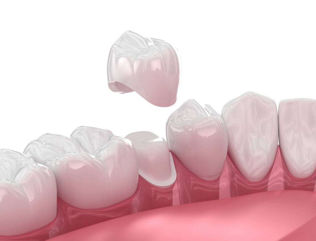 same day dental crown okc Dental crown placement over tooth. 3D illustration
