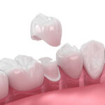 Same-Day Porcelain Crowns in OKC: What You Need to Know
